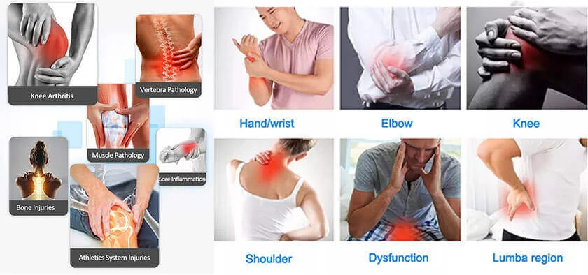Fisioterapia Láser 685/830: aplicaciones