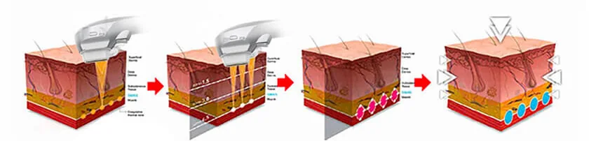 25D HIFU Skin Tightening: equipment detail