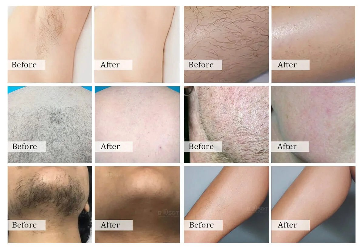 1200W diodo laser 808nm: aplicaciones
