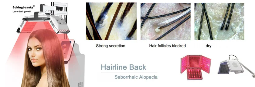 Crecimiento del Cabello con Láser: características