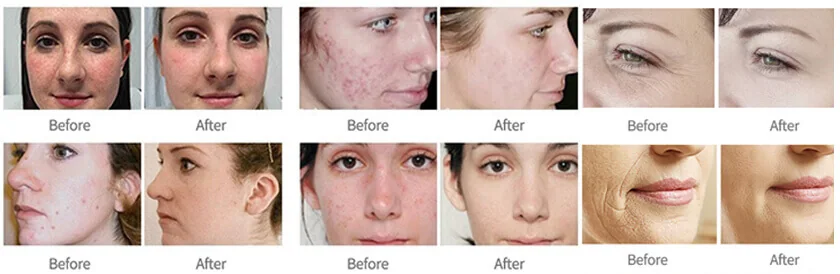 Hydradermabrasion: applications