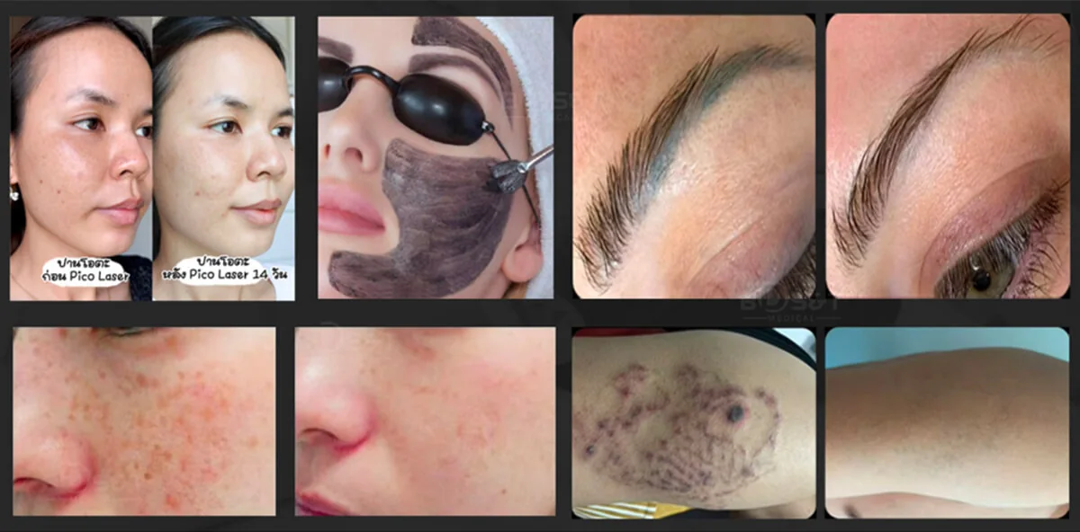 ND Yag Laser : applications