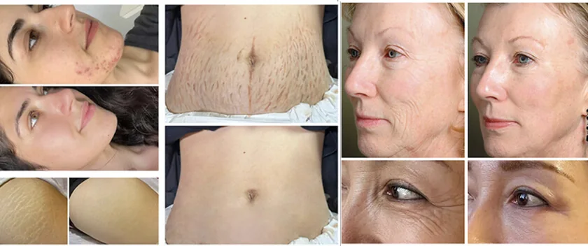 6-in-1 RF Microneedling: applications
