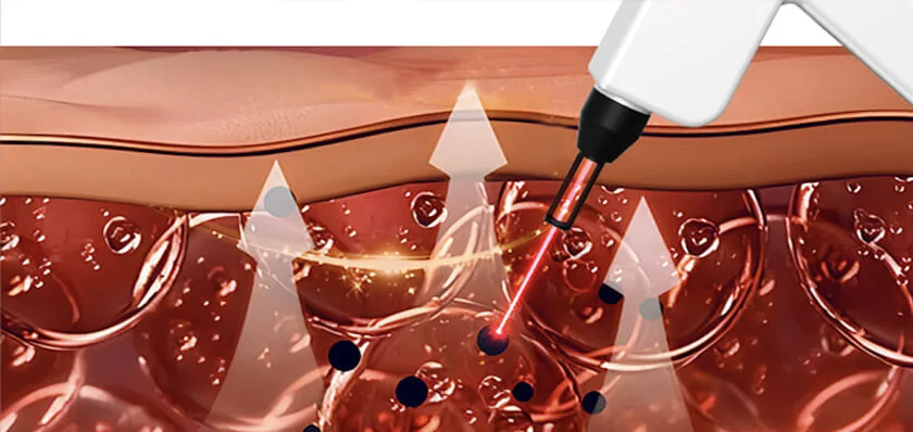 Fractional Laser + Q Switch Laser: equipment detail