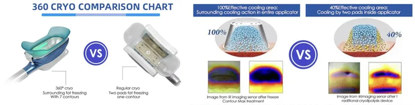 360 Cryolipolysis: features