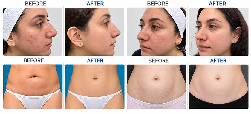 Microneedling RF fraccionado: aplicaciones