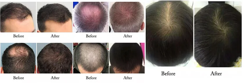 Crecimiento del Cabello con Láser: aplicaciones