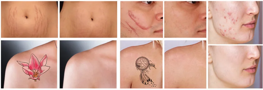 Fractional Laser + Q Switch Laser: applications