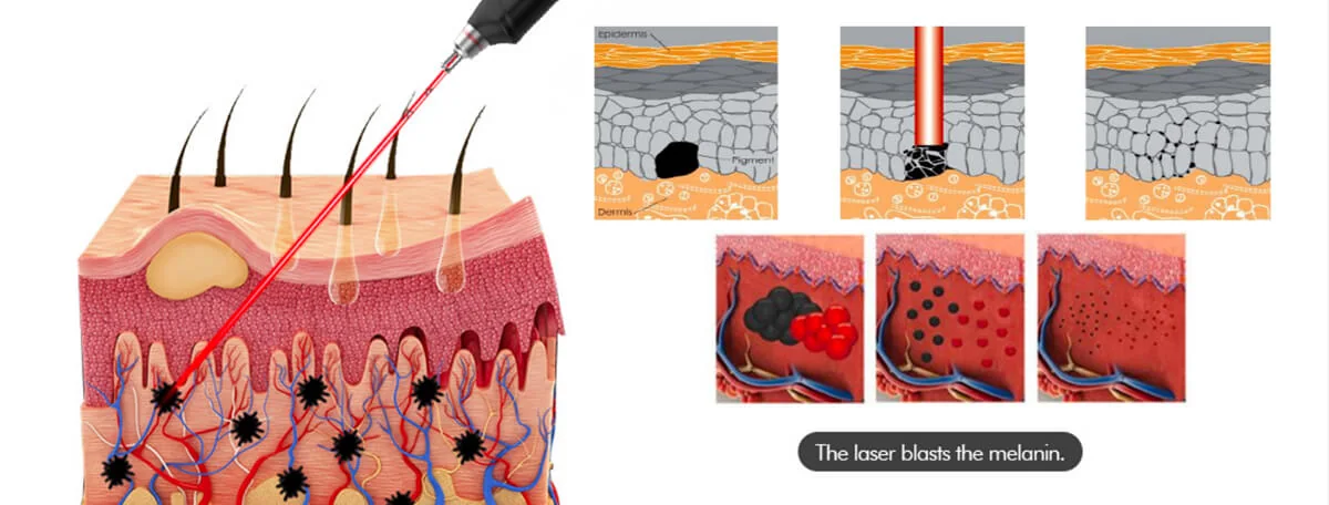 ND Yag Laser : equipment detail