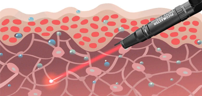 Picosecond Nd Yag Laser: equipment detail