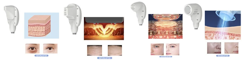 6-in-1 RF Microneedling: equipment detail