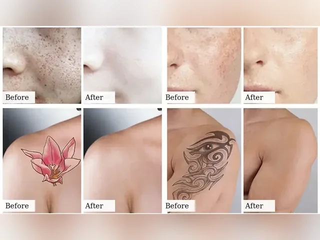 Pico Laser: applications