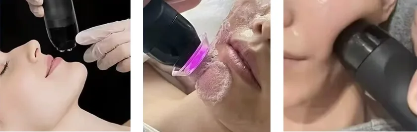  Facial de Burbujas de Oxígeno: características
