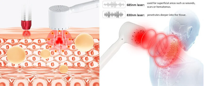 Fisioterapia Láser 685/830: detalle del equipo