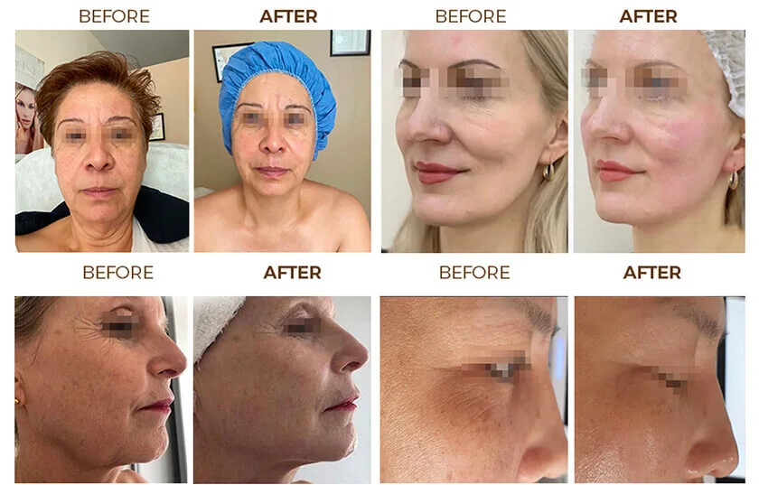 Reference image of 4 IN 1 HIFU