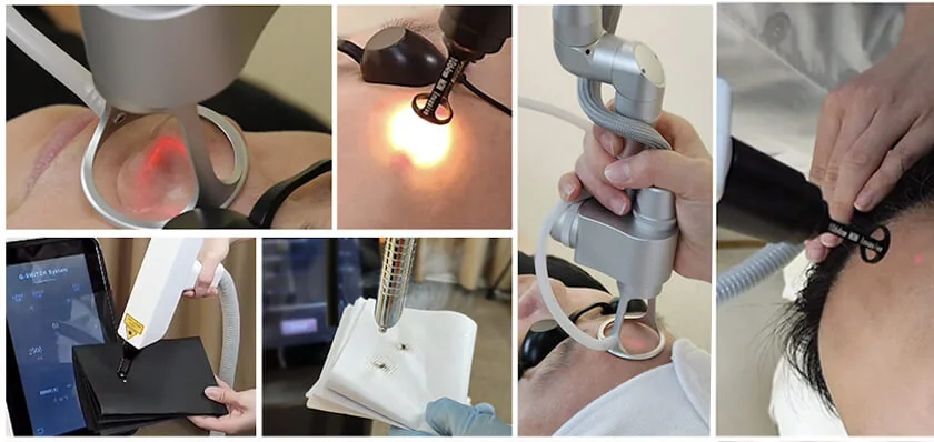 Fractional Laser + Q Switch Laser: features