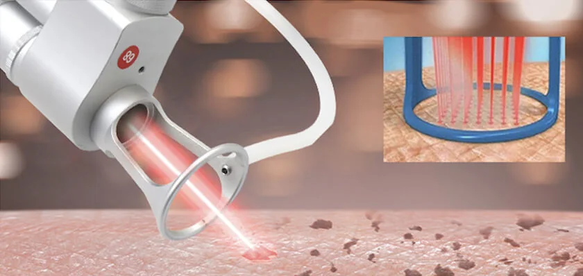 Fractional Laser + Q Switch Laser: equipment detail