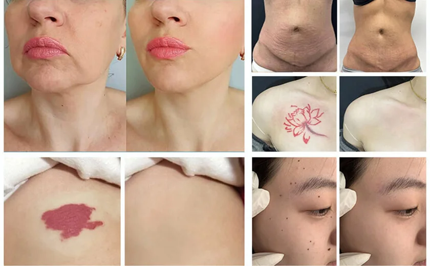 Picosecond Nd Yag Laser: applications